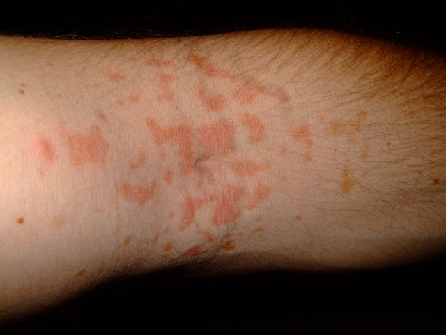 what-s-causing-my-skin-rash-hartsdale-homeopathy